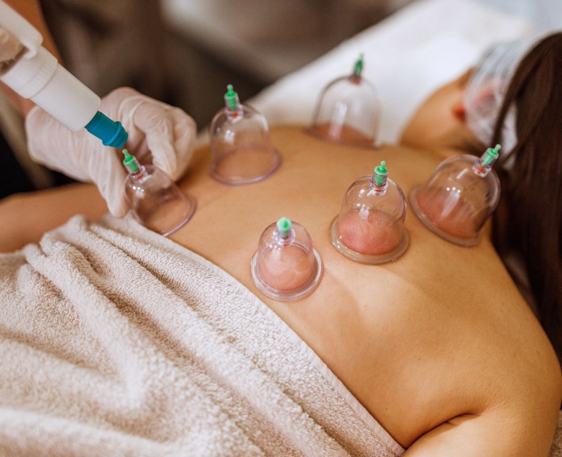 Cupping Therapy (Normal)