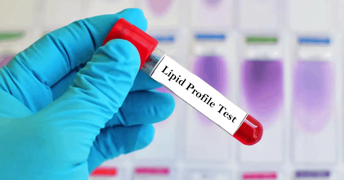 Lipid Profile
